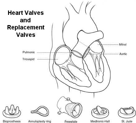 The heart and different replacement valves.